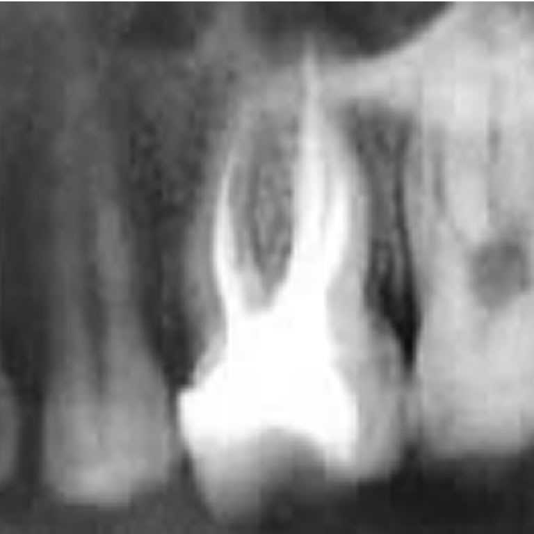 Fluoruro de Plata en Endodoncia