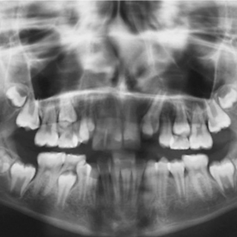 Avulsiones Dentarias